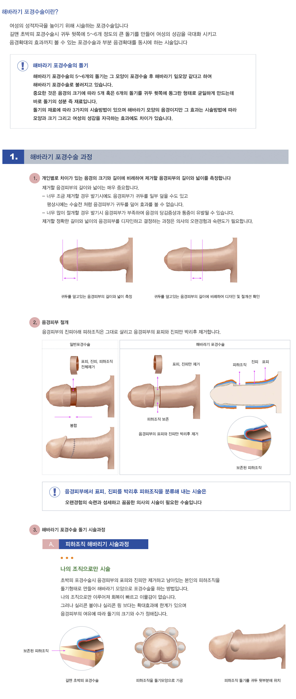 해바라기포경수술 | 길맨